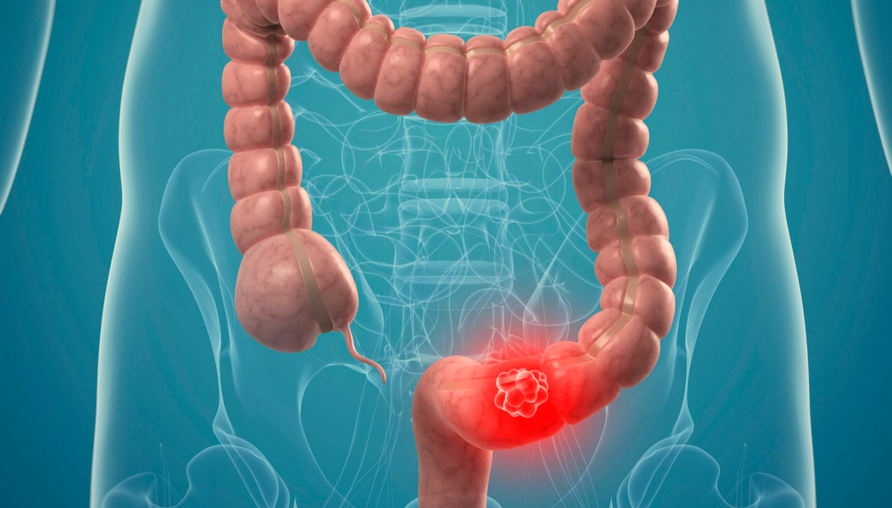 colon cancer.jpg